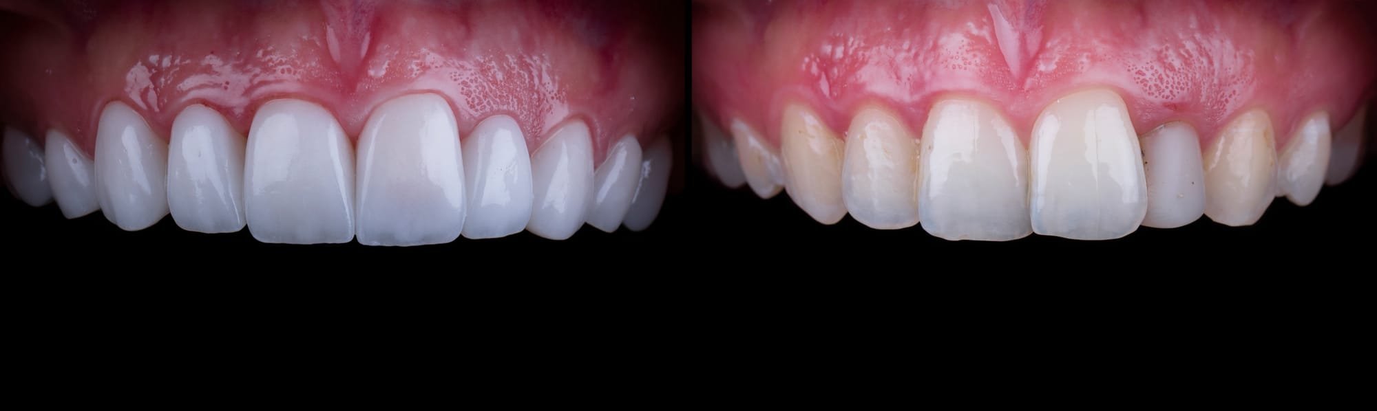 Porcelain Veneers at Versailles Dental Clinic