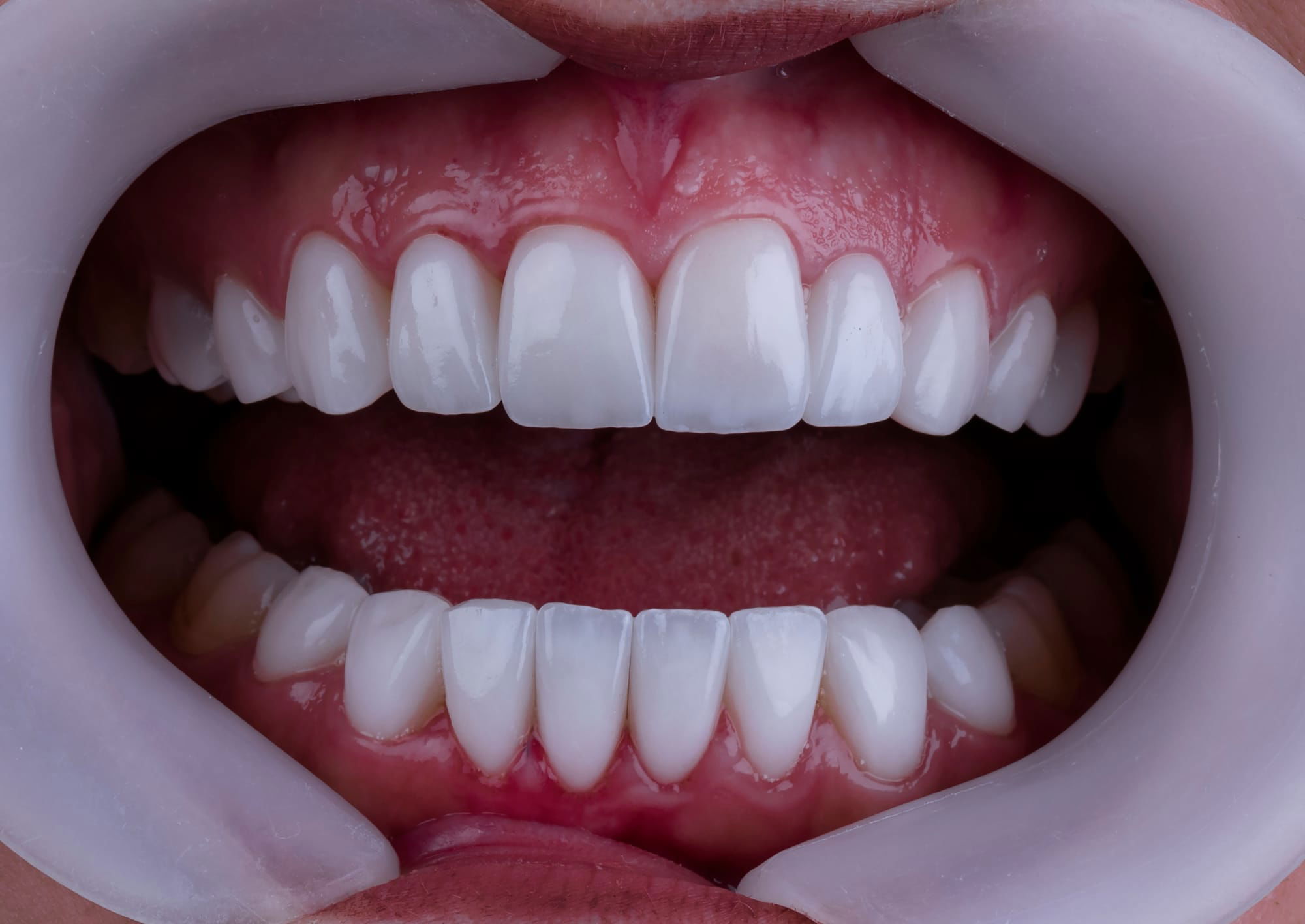 Teeth Whitening at Versailles Dental Clinic
