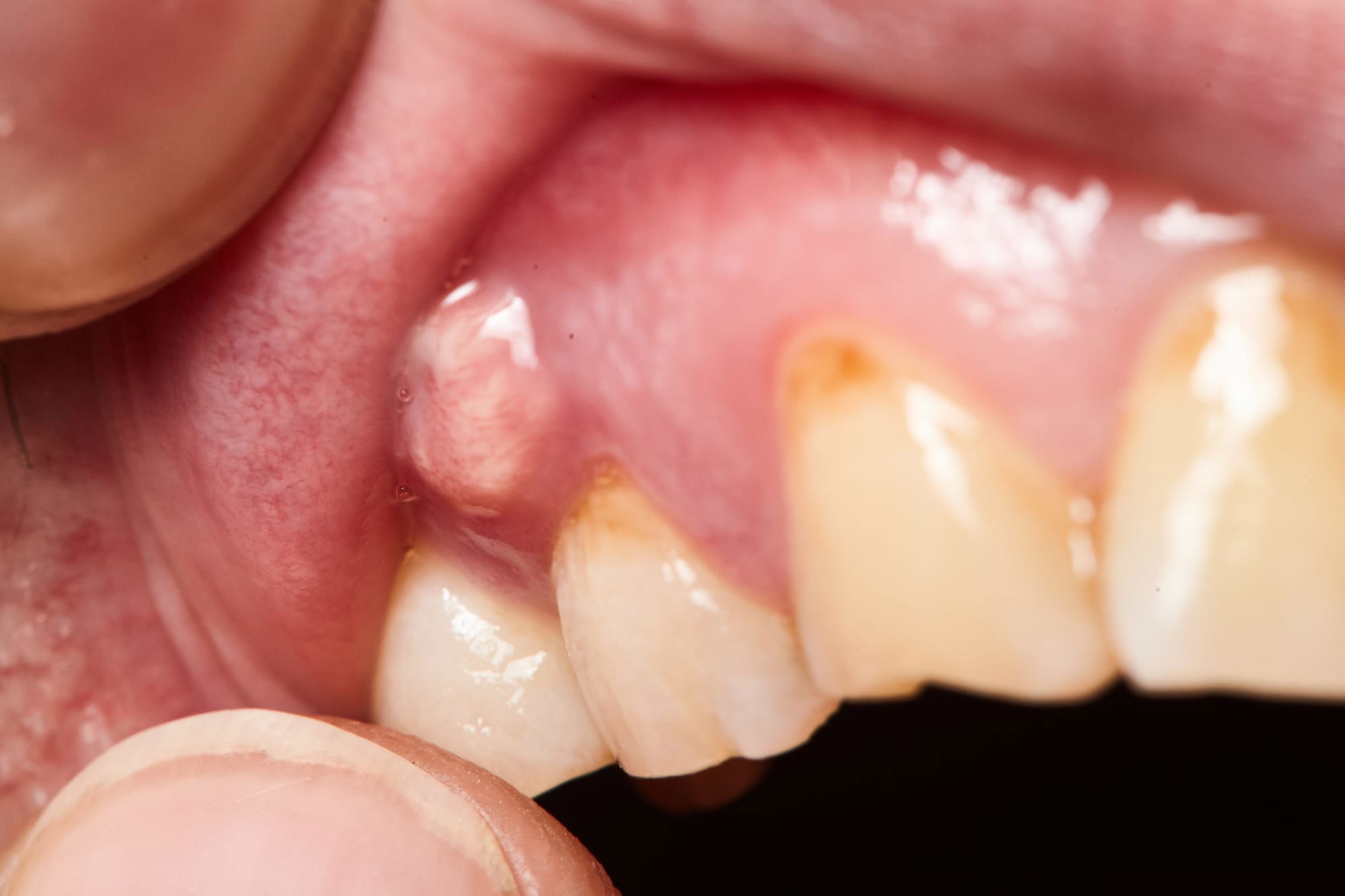 Dental Abscess Treatment Dubai: Urgent Care at Versailles Dental Clinic