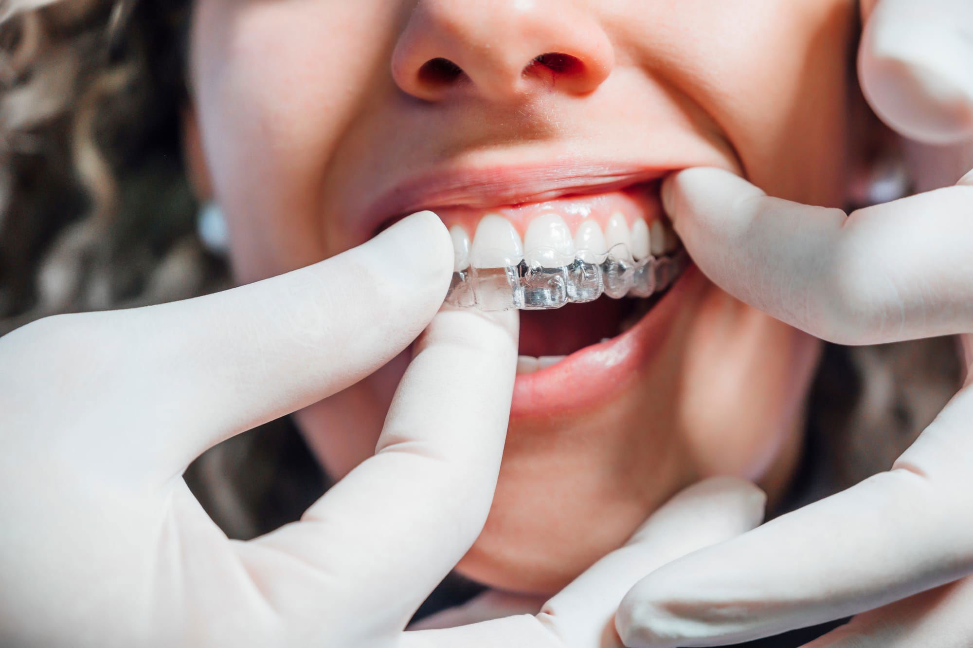 Invisalign: The Clear Path to a Perfect Smile