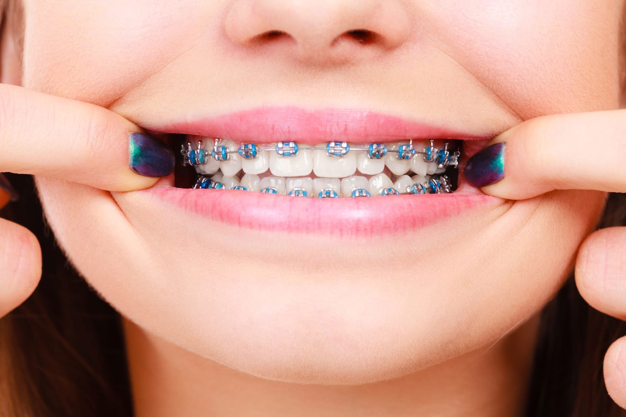 Time-tested metal or ceramic braces, known for their effectiveness in correcting complex dental issues.
