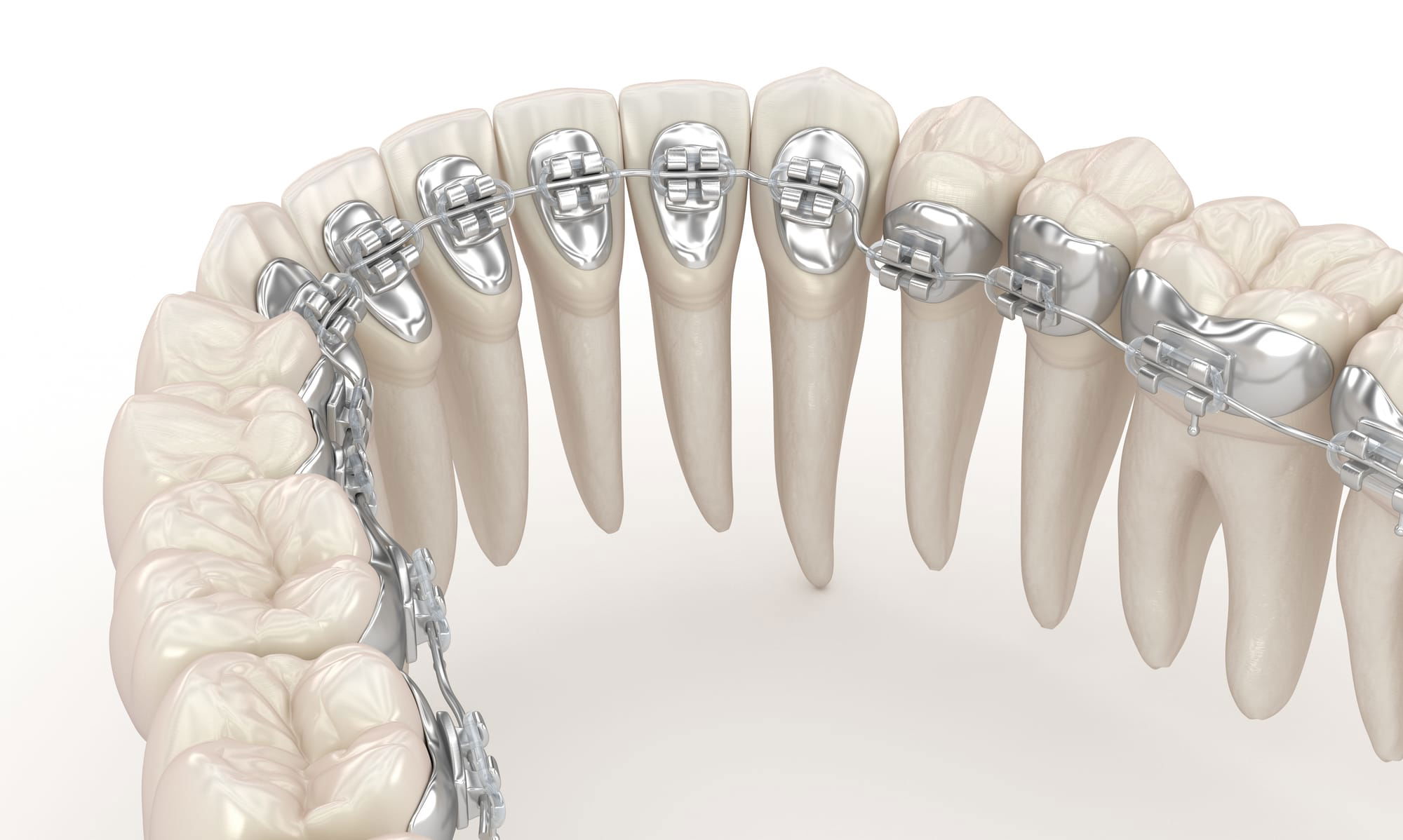 Braces placed behind the teeth, offering a concealed method for teeth straightening.