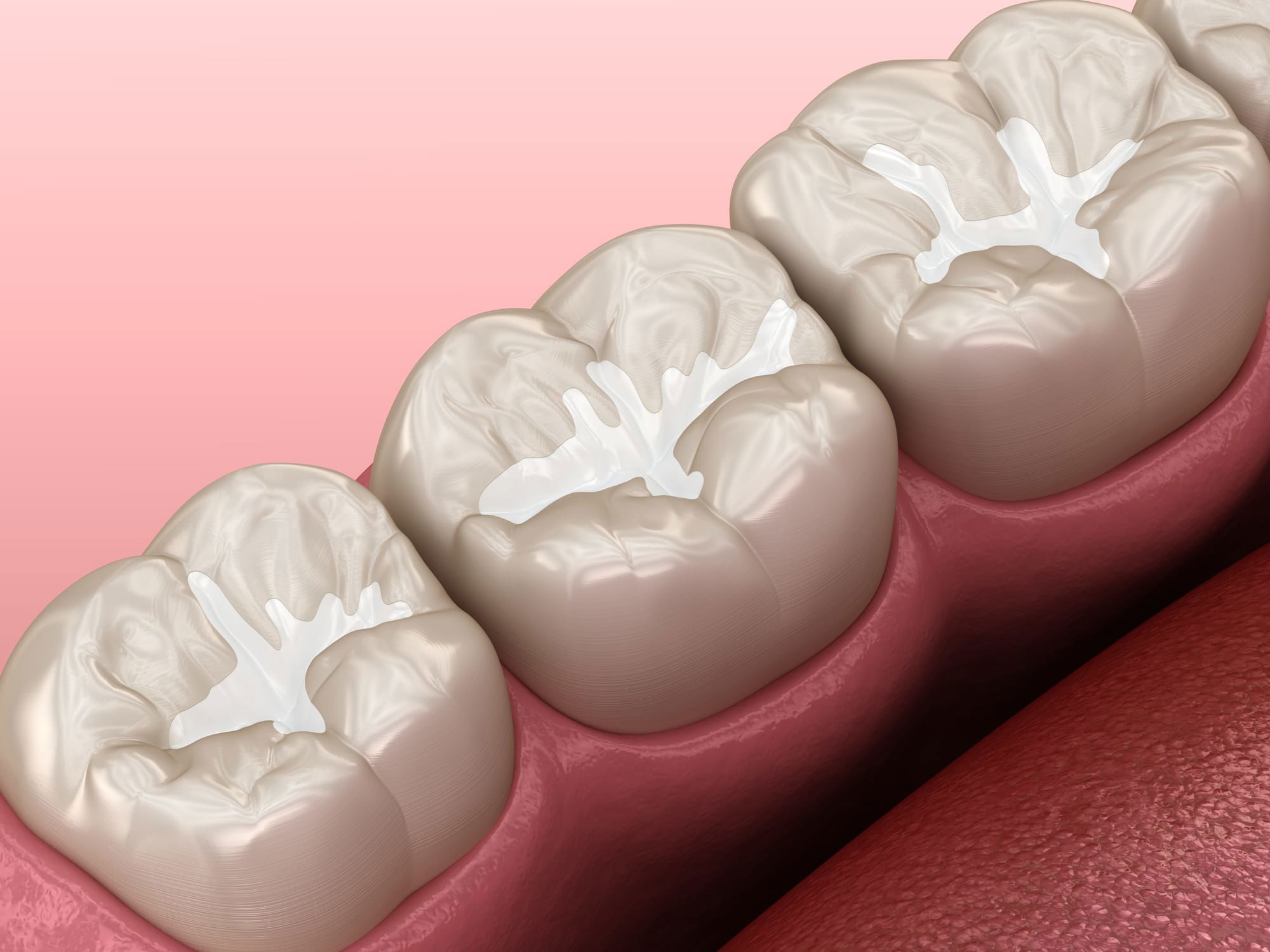 Dental Sealants: Shielding Children’s Teeth from Decay