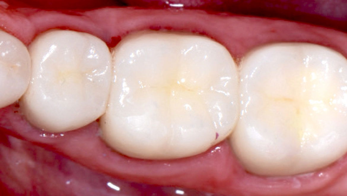 Tooth-Colored Fillings: Blending Aesthetics with Dental Health