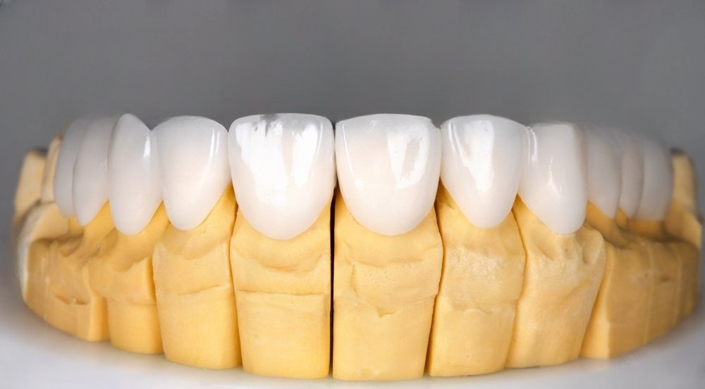 Preparation of Ceramic Dental Veneers 