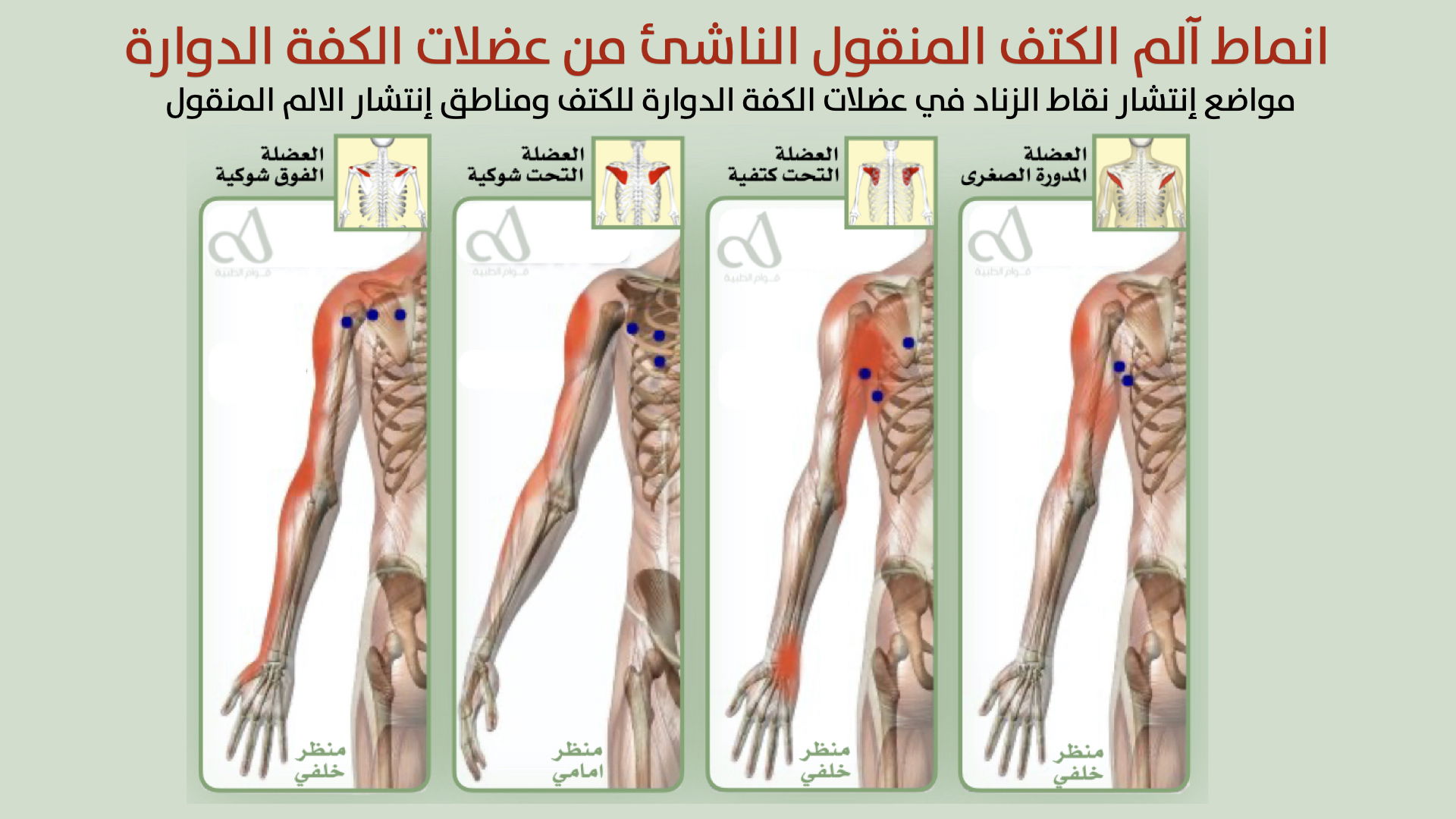 Паттерны передаваемой боли в плече, возникающей из мышц вращающей манжеты плеча